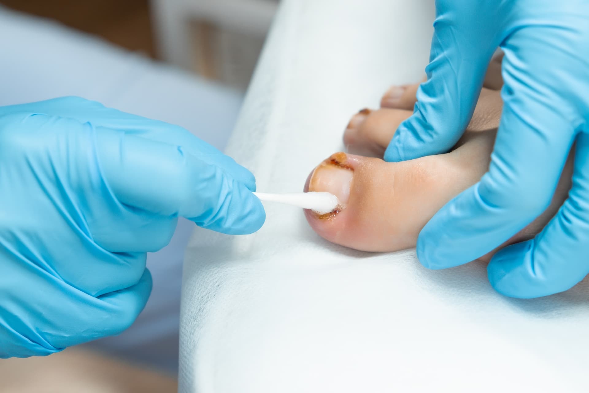 Ingrown Toenails provided at home by a qualified foot health practitioner in Hertfordshire
