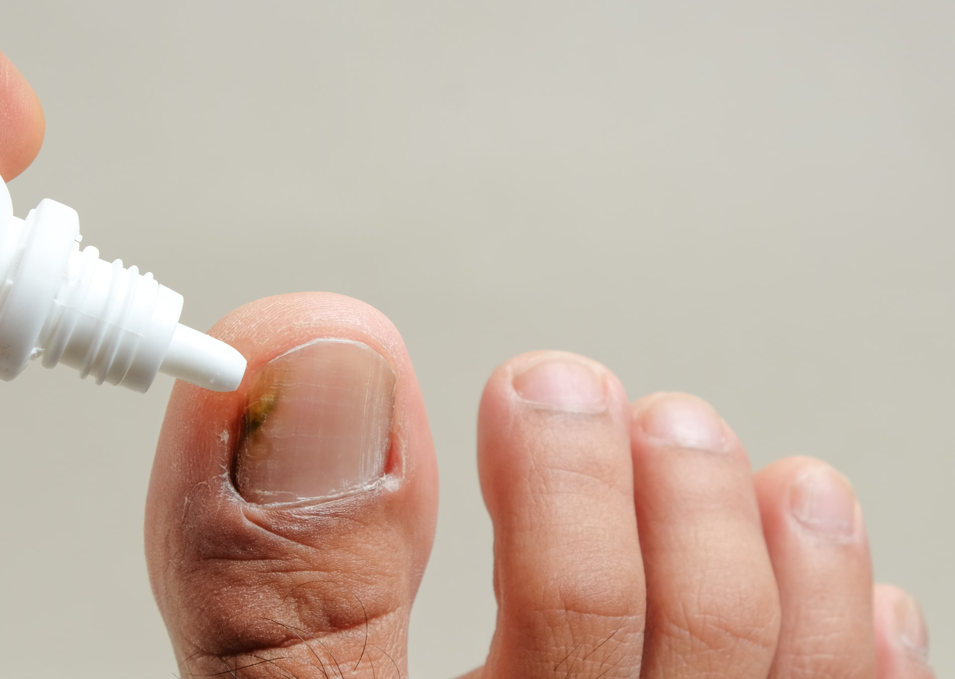 Fungal Nail Infections provided at home by a qualified foot health practitioner in Hertfordshire