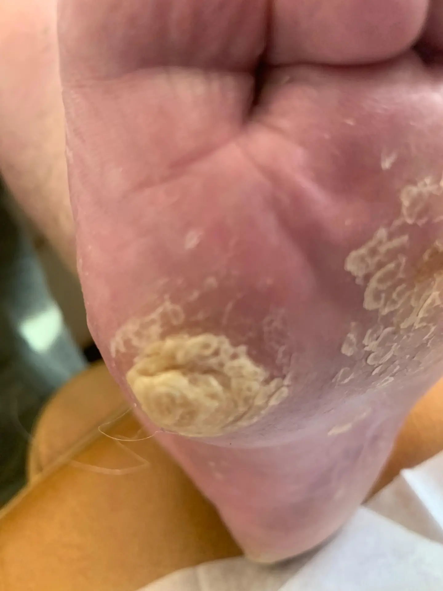 Before treatment: a hard corn and thickened callus on the underside of the toe and forefoot