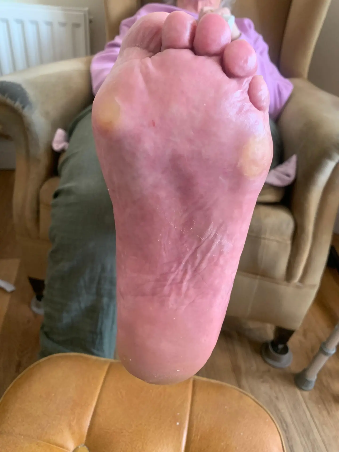 After treatment: the sole of the foot with corn and callus reduced and the skin left smooth