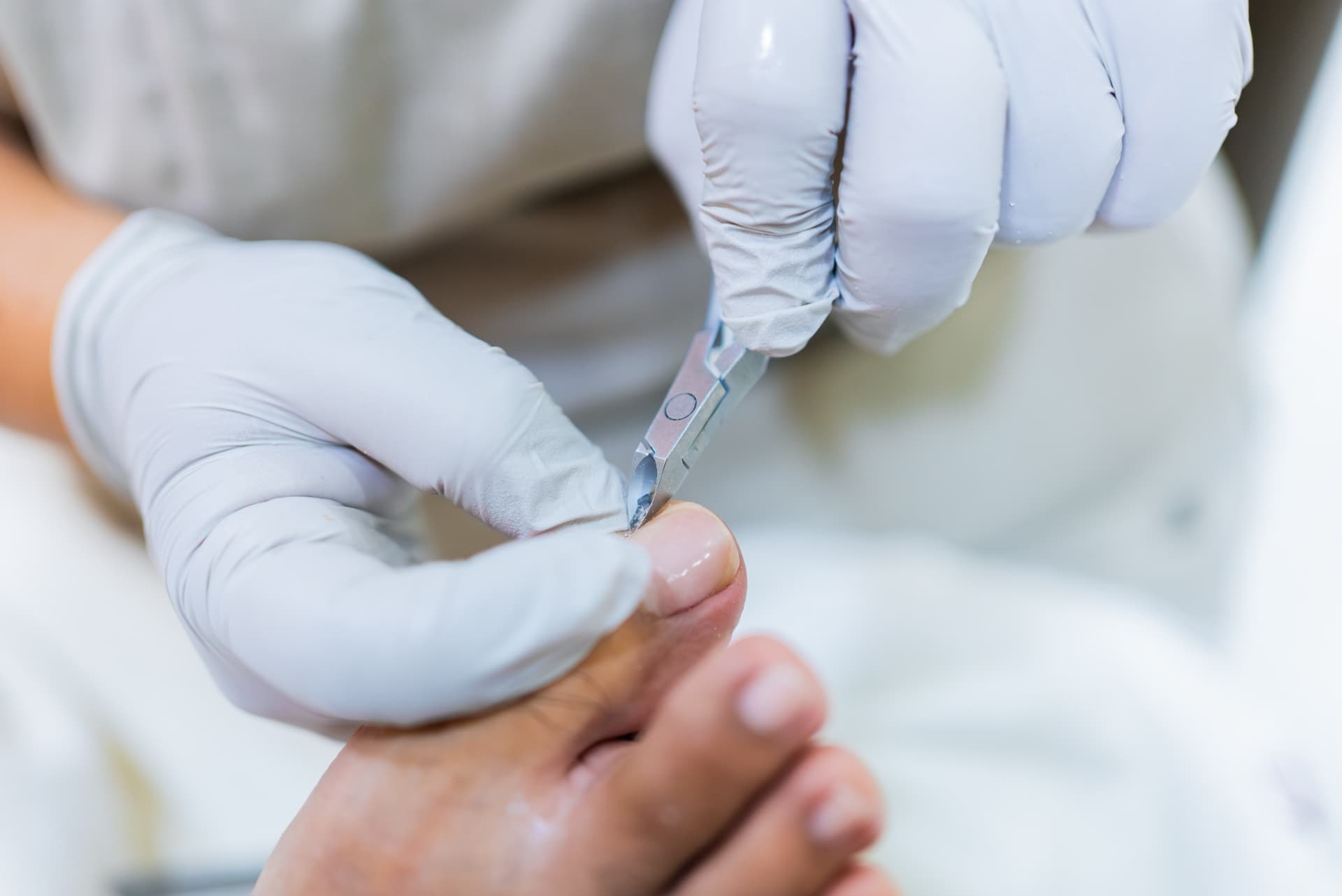 Thickened Toenail Treatment provided at home by a qualified foot health practitioner in Hertfordshire