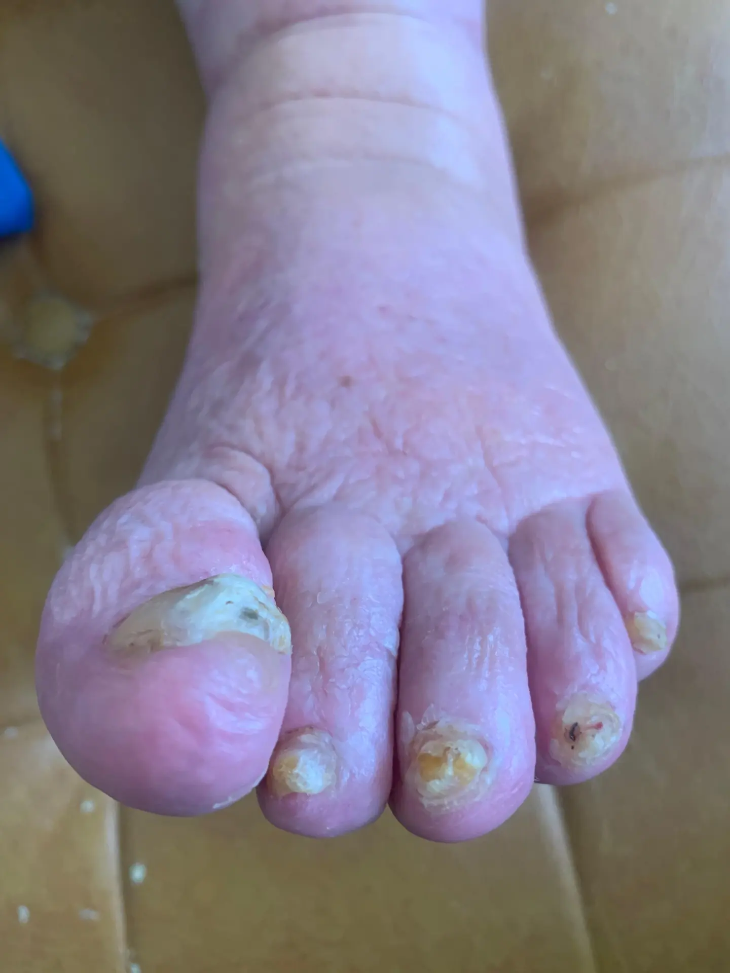 After treatment: the same toenails reduced in thickness and length, with the natural nail shape restored