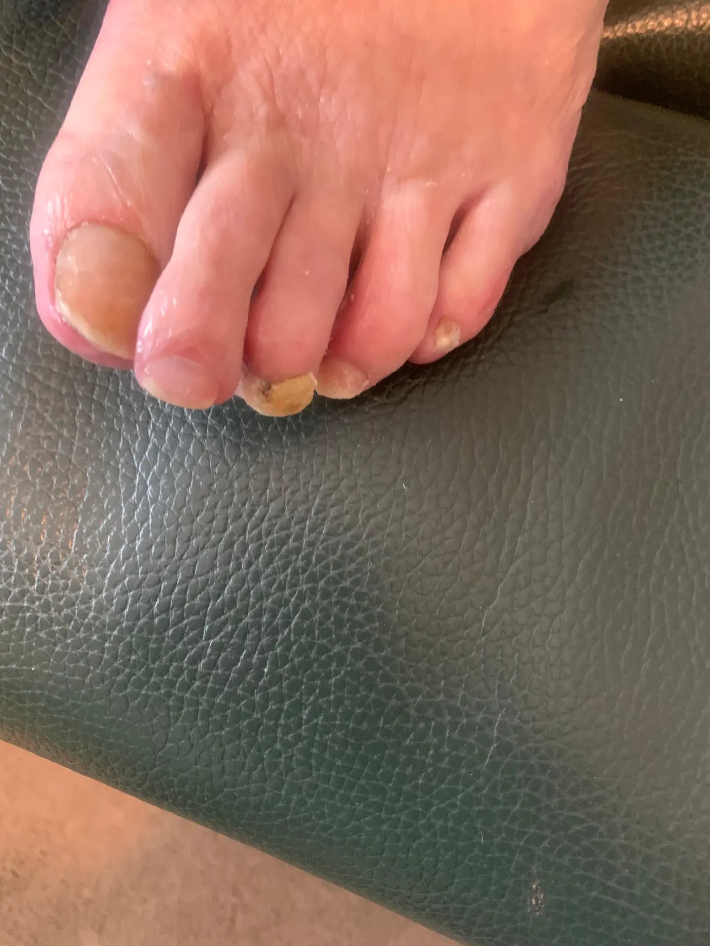 After treatment: the same toenails cut back and reduced, with the affected nail tidied and dressed