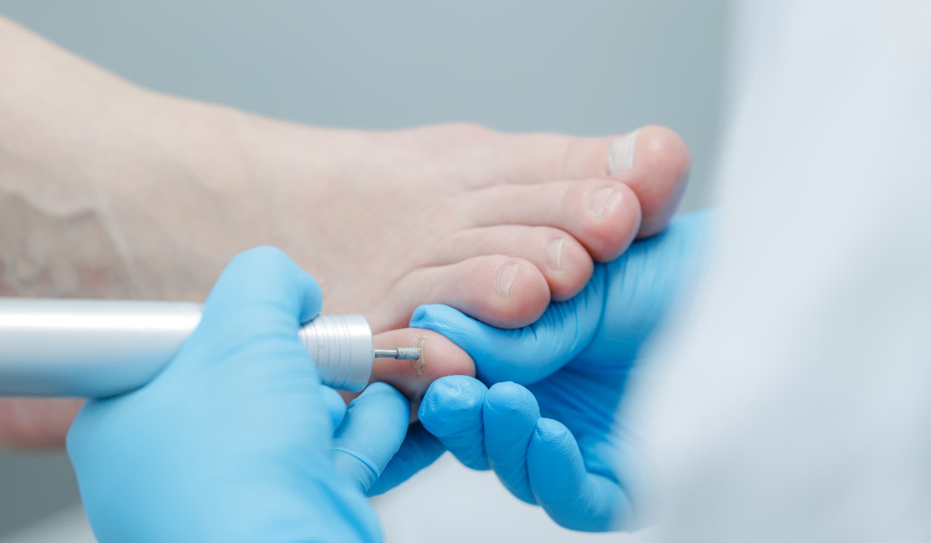 Involuted Toenail provided at home by a qualified foot health practitioner in Hertfordshire