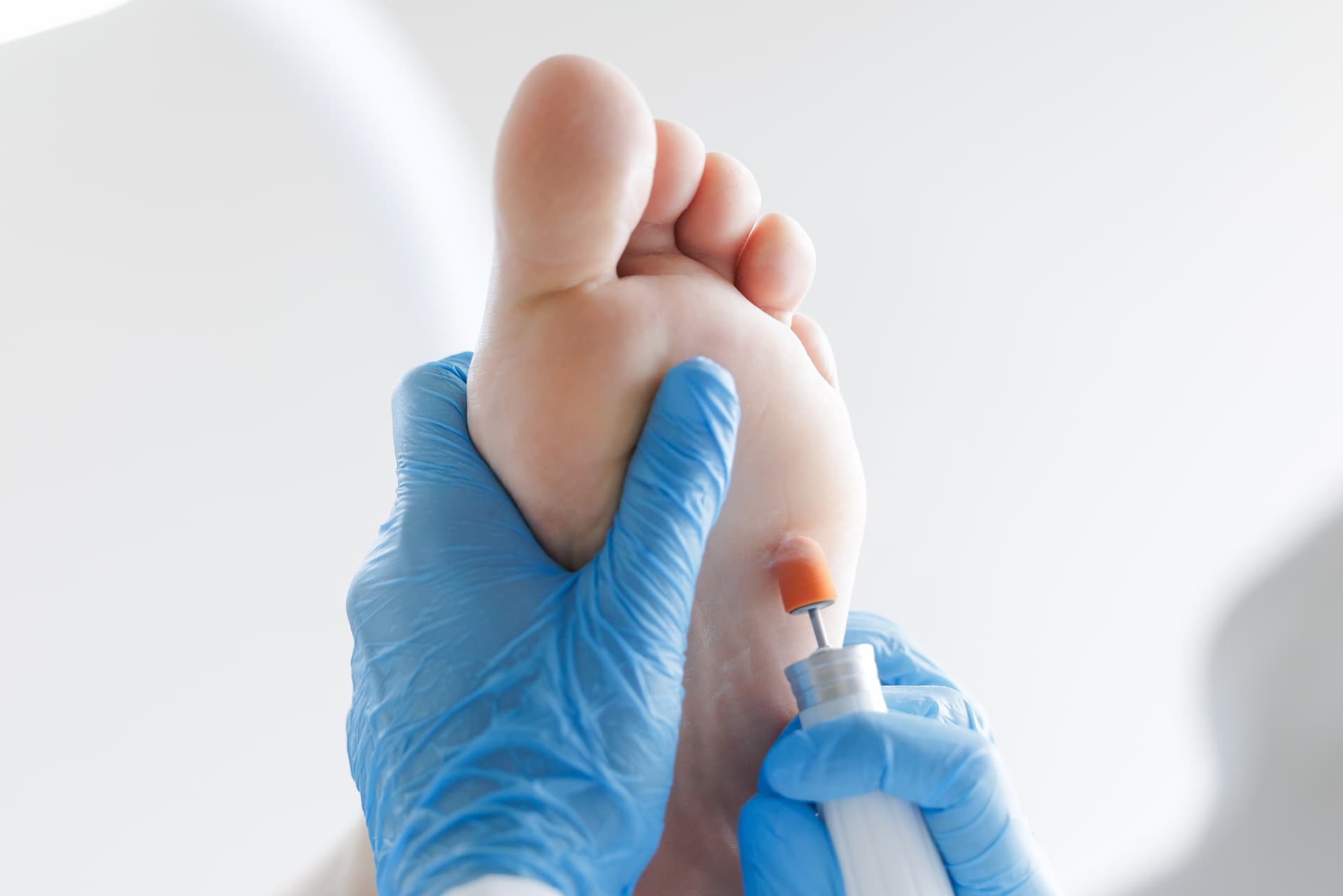 Verrucae Treatment provided at home by a qualified foot health practitioner in Hertfordshire