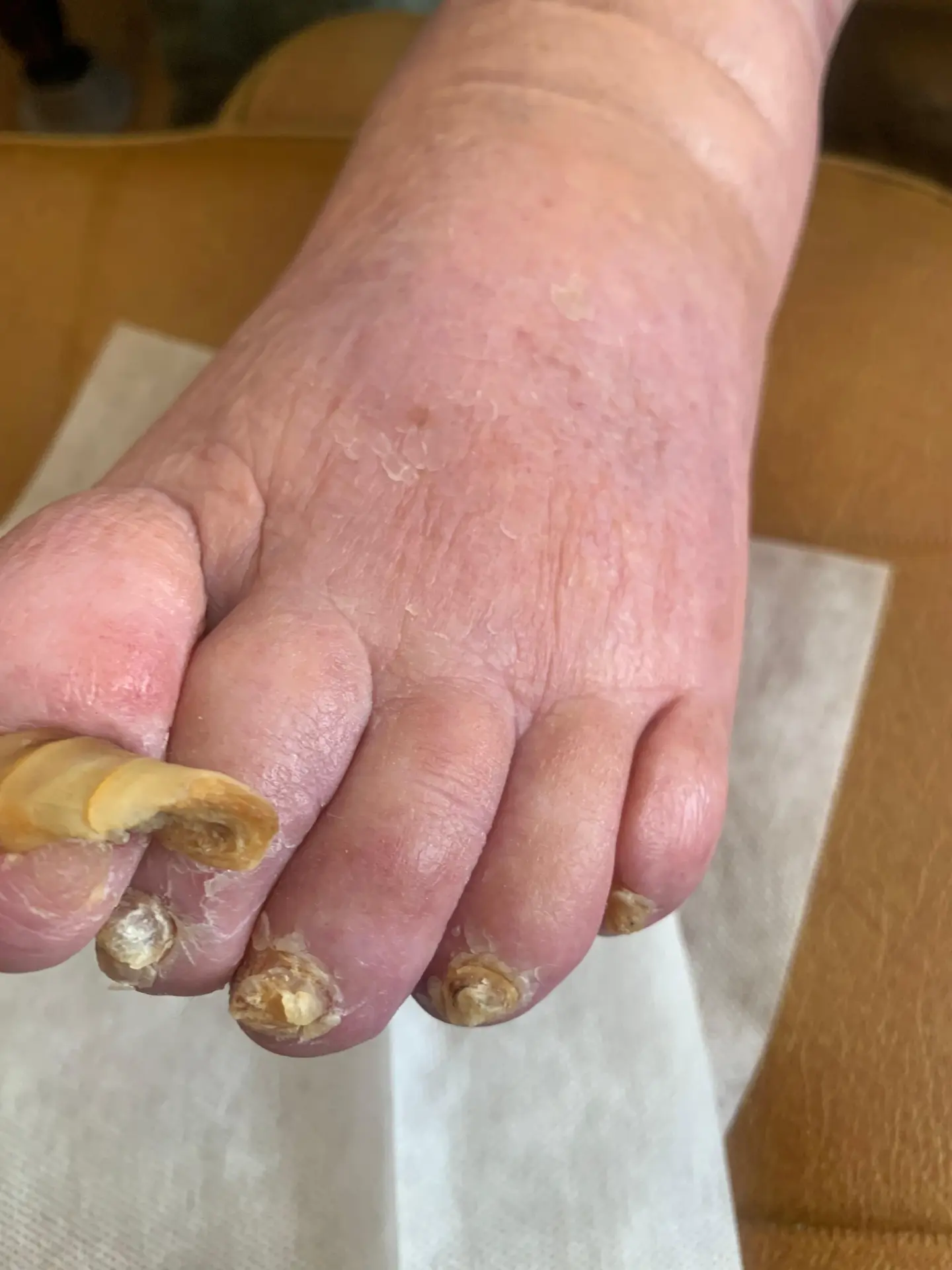 Before treatment: severely thickened, overgrown toenails on an elderly client's foot during a home visit in Hertfordshire